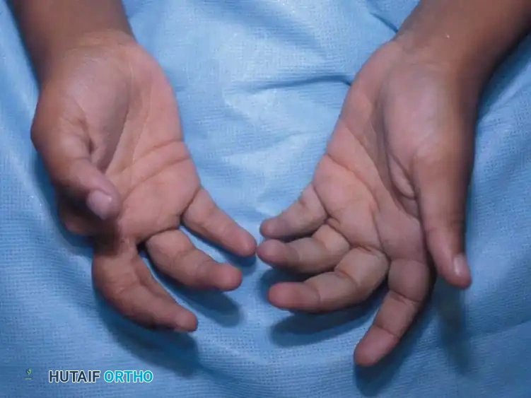 CONGENITAL RING SYNDROME Surgical Diagram