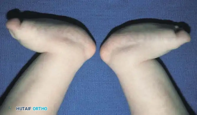 Fig. 26-46 A, Bilateral congenital vertical talus in 14-month-old child. B, At 6 years of age, after bilateral operative correction at age 14 months in which transverse circumferential approach was used.