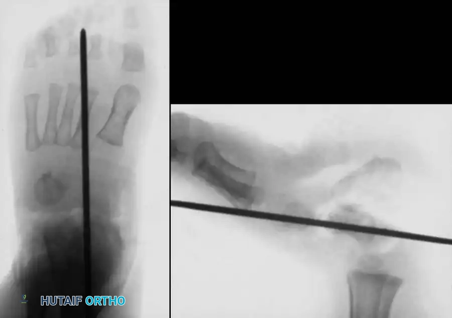 CONGENITAL VERTICAL TALUS Surgical Diagram