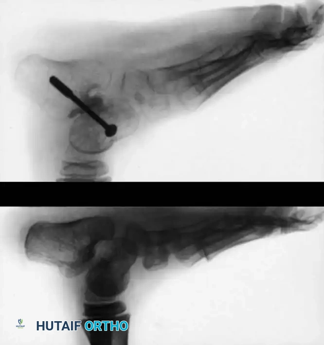 CONGENITAL VERTICAL TALUS Surgical Diagram