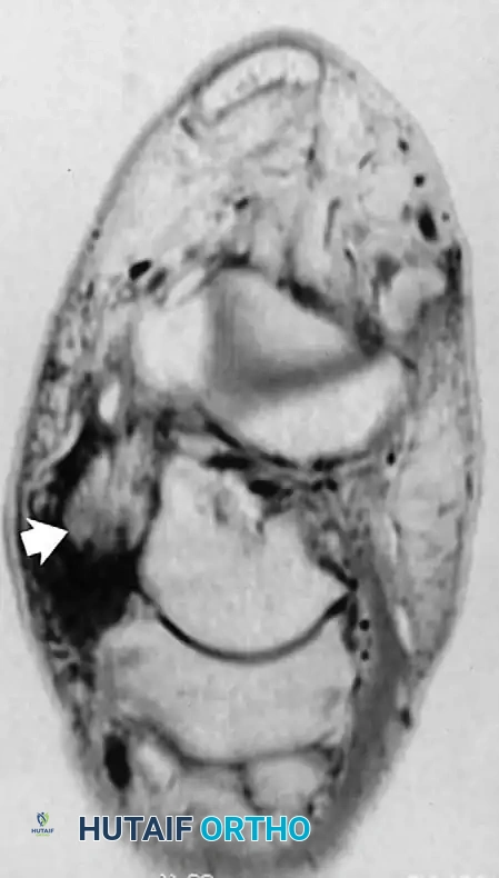 Posterior tibial tendon tear B