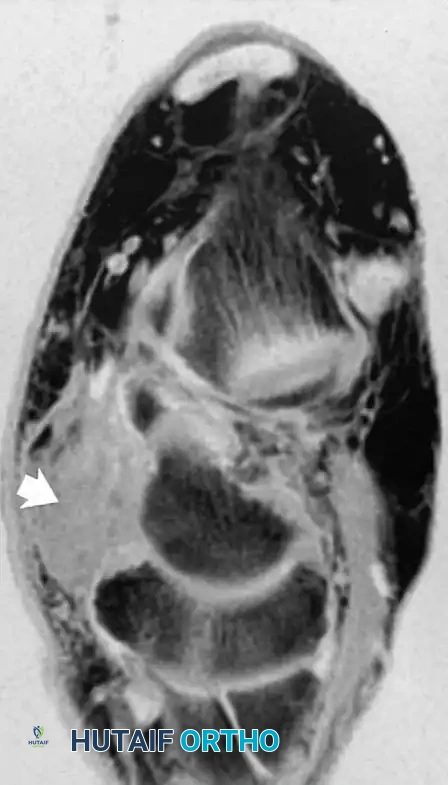 Posterior tibial tendon tear A