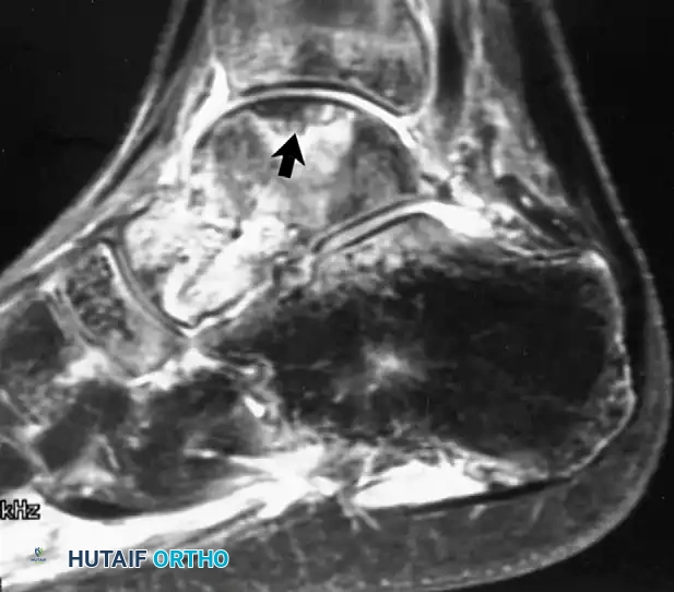 Osteonecrosis of talus
