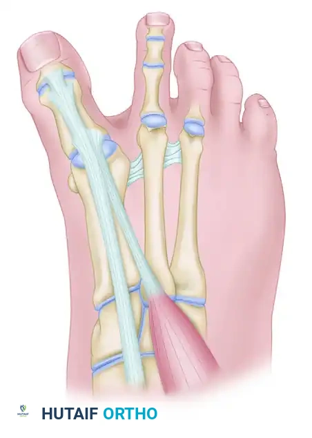 CORRECTION OF DYNAMIC (MULTIPLANAR) HALLUX VARUS Surgical Diagram