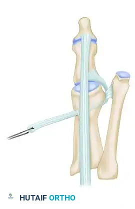 CORRECTION OF DYNAMIC (MULTIPLANAR) HALLUX VARUS Surgical Diagram
