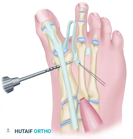 CORRECTION OF DYNAMIC (MULTIPLANAR) HALLUX VARUS Surgical Diagram