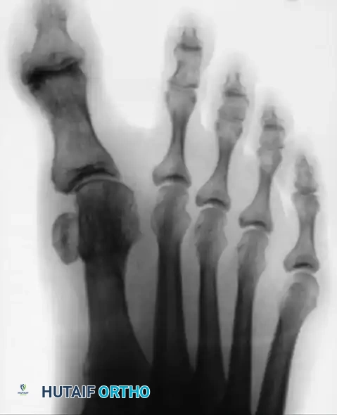 CORRECTION OF DYNAMIC (MULTIPLANAR) HALLUX VARUS Surgical Diagram