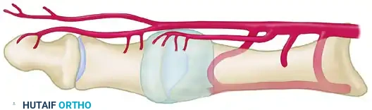 Safe zone for osteotomy Safe zone for lateral capsular release Osteotomy