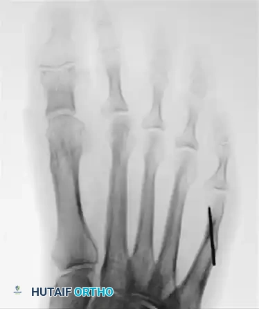 CORRECTION OF MALUNION Surgical Diagram