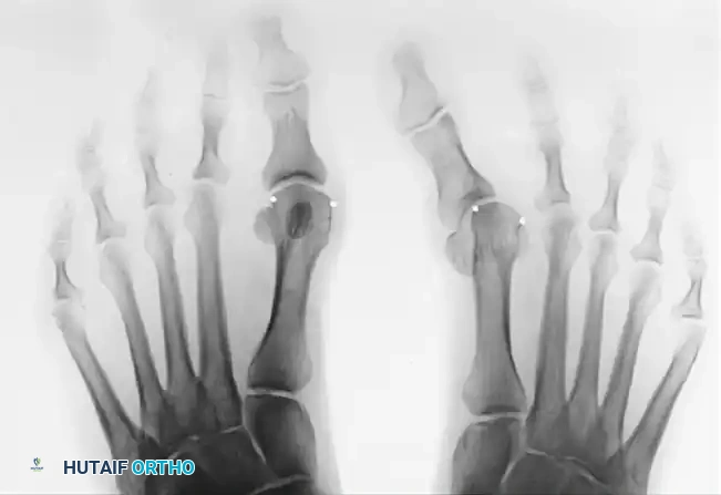 CORRECTION OF MALUNION Surgical Diagram