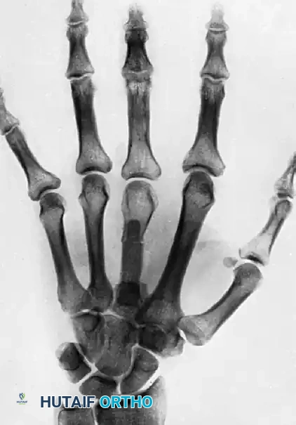 تثبيت السلاميات بعد القطع العظمي التصحيحي