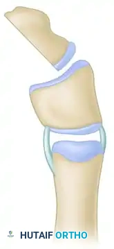 Peimer reduction osteotomy. C, Excision of distal epiphysis.