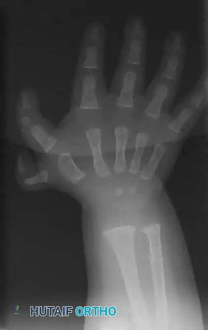 Peimer reduction osteotomy. A, Dorsal incision.