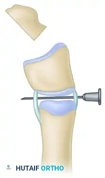 Peimer reduction osteotomy. D, Needle placed across interphalangeal joint.