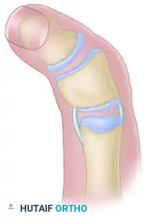 Peimer reduction osteotomy. G, Bone ends are fixed with smooth wires.