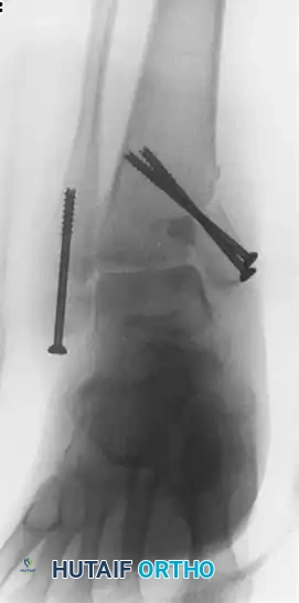 جراحة تصحيح الاندمال المعيب لكسور الكعب والكاحل | الدليل الطبي الشامل