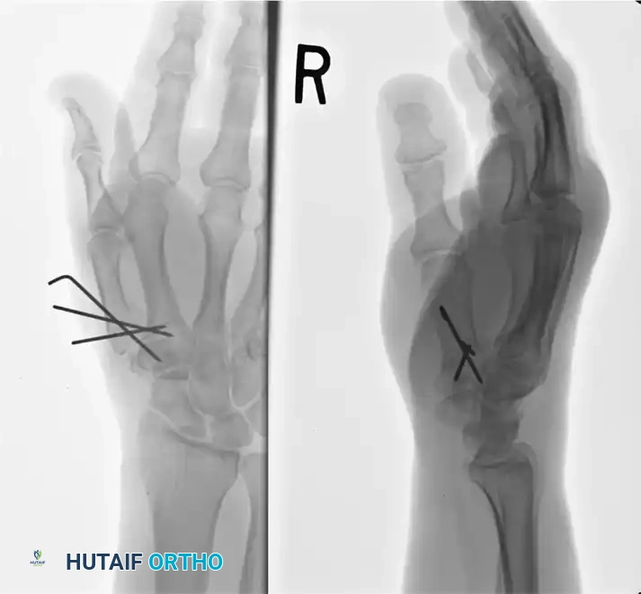 First Metacarpal Corrective Osteotomy and Management of Rolando Fractures