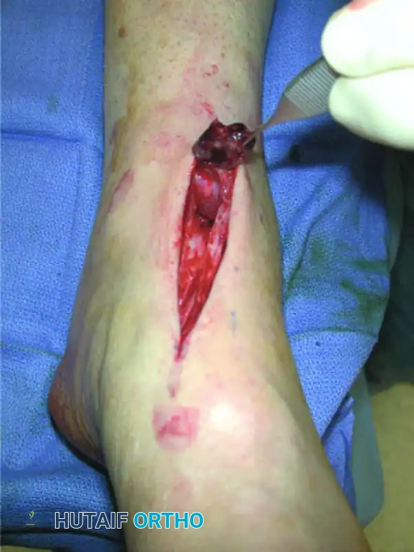 Comprehensive Surgical Management of Anterior Tibial and Peroneal Tendon Disorders