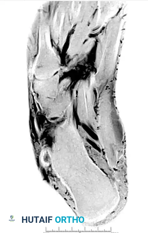 DÉBRIDEMENT OF THE PERONEUS LONGUS TENDON, REMOVAL OF OS PERONEUM, AND TENODESIS OF PERONEUS LONGUS TENDON TO PERONEUS BREVIS TENDON Surgical Diagram