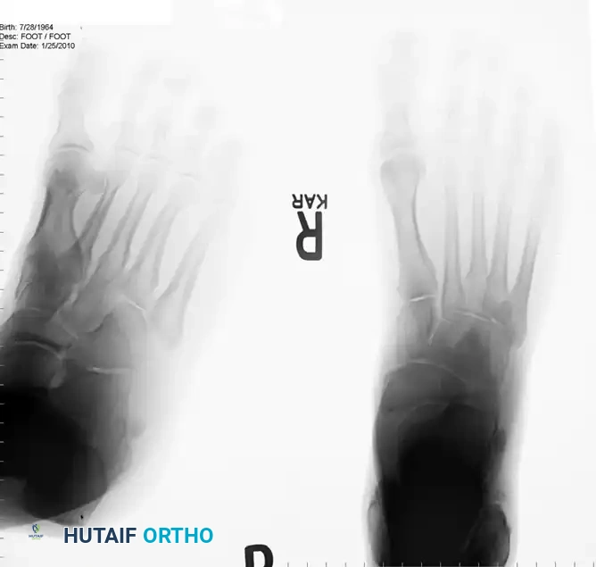 DÉBRIDEMENT OF THE PERONEUS LONGUS TENDON, REMOVAL OF OS PERONEUM, AND TENODESIS OF PERONEUS LONGUS TENDON TO PERONEUS BREVIS TENDON Surgical Diagram