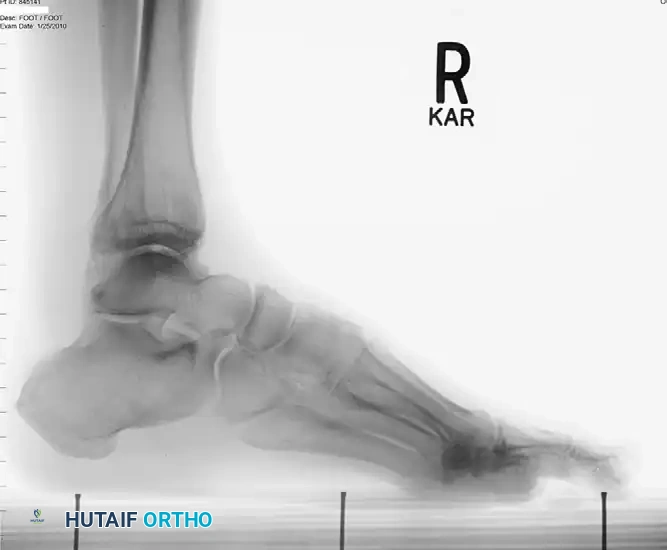 Peroneal Tendon Surgery: Debridement & Tenodesis Guide