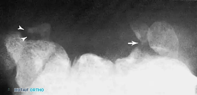 Fig. 66-11 Carpal tunnel view shows avulsion fracture of hamate hook (arrow) and trapezium (arrowheads). (From Gilula LA, Destouet JM, Weeks PM, et al: Roentgenographic diagnosis of the painful wrist, Clin Orthop Relat Res 187:52, 1984.)