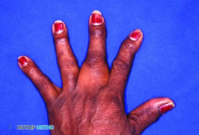 Benign Tumors of the Hand: Diagnosis, Staging, and Surgical Management