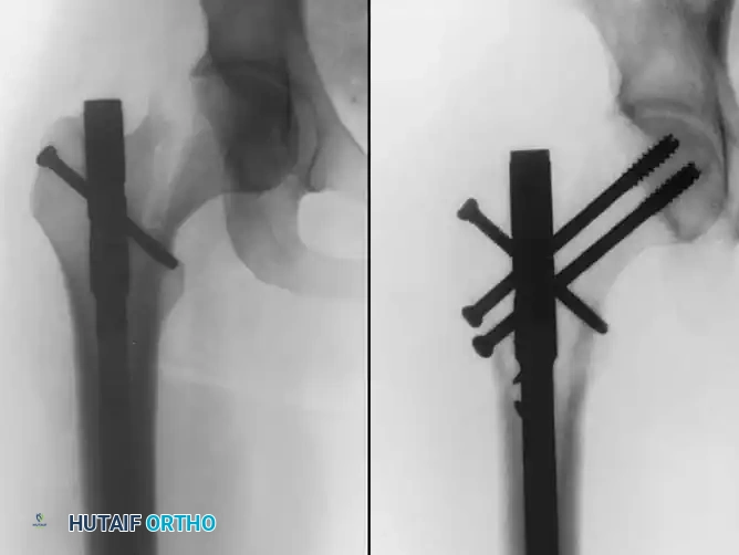 Operative Management of Hip Dislocations and Fracture-Dislocations