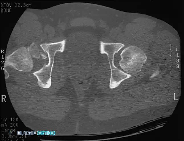 Fig. 52-46 CT scan shows retained bone fragment within articulation of femoral head in acetabulum; excision of fragment is indicated.
