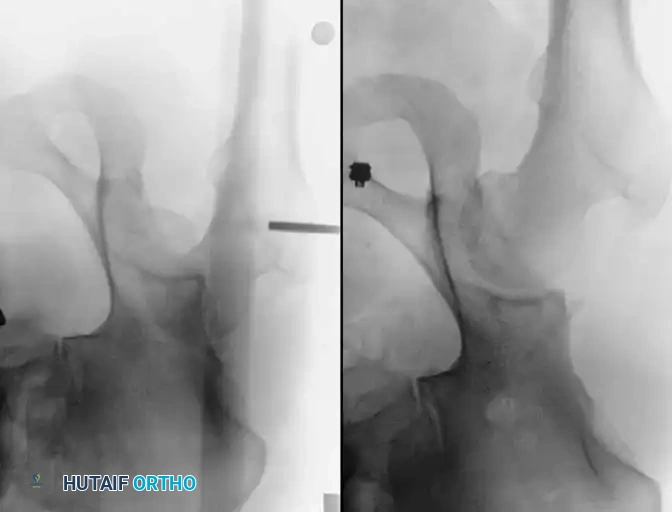 DISLOCATION AND FRACTUREDISLOCATION OF THE HIP Surgical Diagram