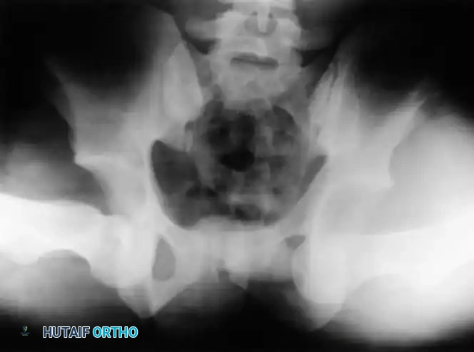 DISLOCATION AND FRACTUREDISLOCATION OF THE HIP Surgical Diagram