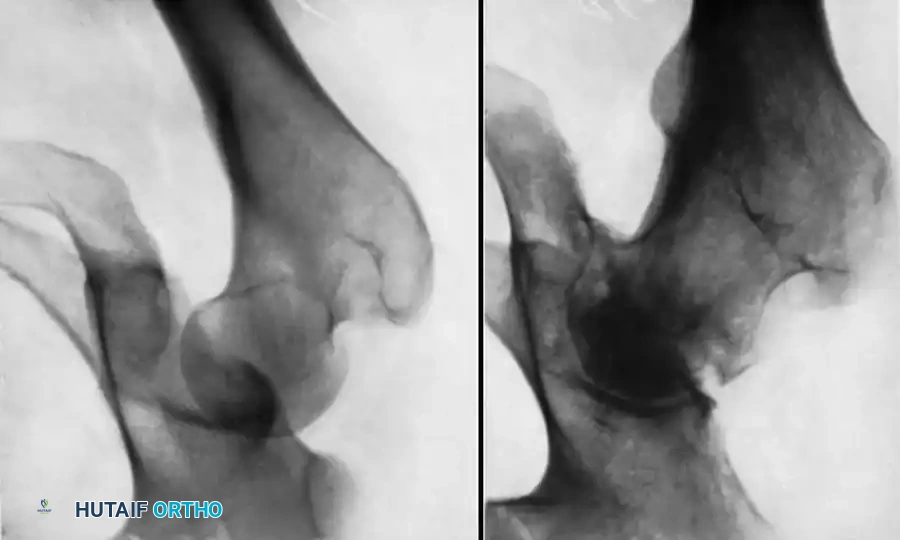 DISLOCATION AND FRACTUREDISLOCATION OF THE HIP Surgical Diagram