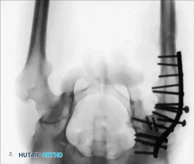 DISLOCATION AND FRACTUREDISLOCATION OF THE HIP Surgical Diagram