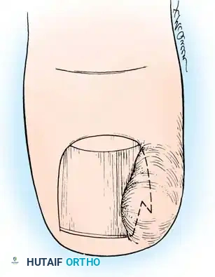 Fig. 84-1 A, Anatomy of normal toenail (see text). B, Ingrown toenail (see text). C, Cross section of ingrown toenail (see text). D, Nail is lifted with cotton.