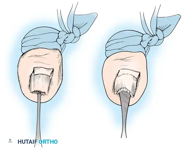 Disorders of Nails and Skin Surgical Diagram