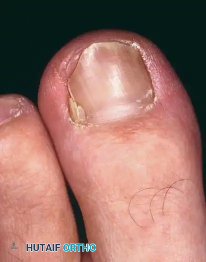 Fig. 84-5 Inadequate partial nail plate removal. Lateral fourth of nail plate should be removed beneath eponychium.