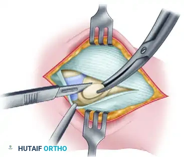 Flush Resection of Navicular