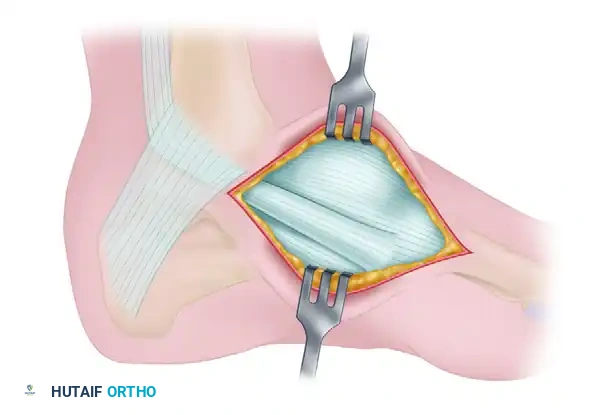Removal of Accessory Navicular