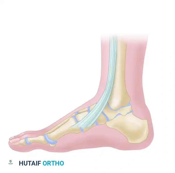 Incision for anterior tibial tendon