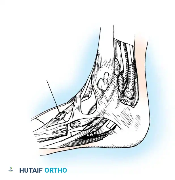 Bursa under anterior tibial tendon