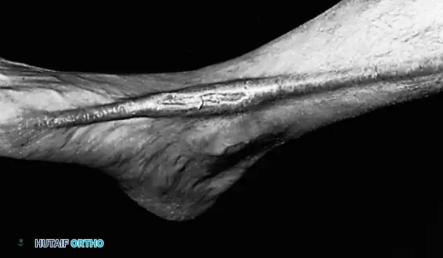 Fig. 85-27 Hypertrophic scar across anteromedial aspect of ankle.