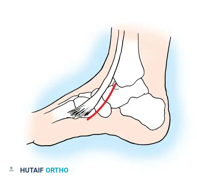 Anterior tibial tendon
