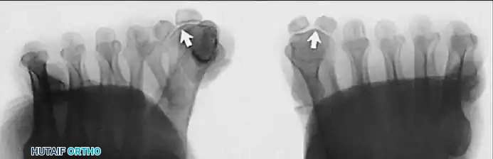 Fig. 78-5 A, Plantar surface of fi rst metatarsal head. Entire sesamoid sling with attached intrinsic musculature has been rotated distally off metatarsal head to present schematically relationships of muscle, tendon, capsule, ligaments, and articular confi guration of fi rst metatarsophalangeal joint. B, As metatarsal head moves medially, sesamoid sling apparatus becomes valgus deforming force, and metatarsal rotates (pronates) on its longitudinal axis. Intrinsic and extrinsic muscle balance is lost, and deformity increases. ( A after Beverly Kessler; courtesy of LTI Medica and The Upjohn Company.)