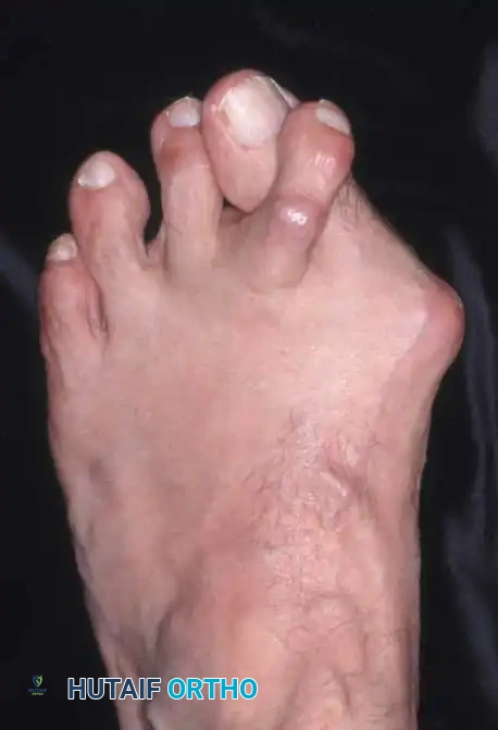 Fig. 78-7 Hammer toe deformity. Note severe crossover-toe deformity of second toe associated with severe hallux valgus. Primary complaint frequently is not severe hallux valgus deformity, but pain beneath second metatarsal head.