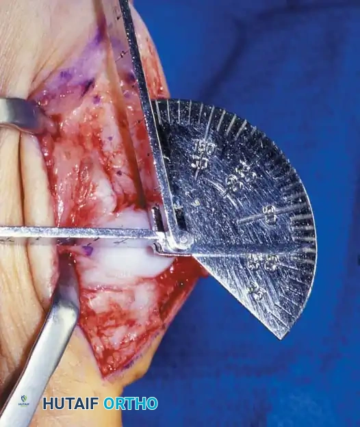 Disorders of the Hallux Surgical Diagram