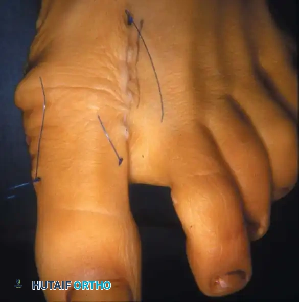 Fig. 78-12 Hallux valgus treated by modifi ed McBride procedure. A, Preoperative deformity in 30-year-old patient. B, Correction obtained at surgery. C, Preoperative and postoperative radiographs (note fi bular sesamoid was not removed). More deformity can be corrected by fi bular sesamoidectomy, but overcorrection (hallux varus) is risk. If fi bular sesamoid is excised, medial capsule should be closed while holding hallux in 5 to 10 degrees valgus and kept in that position until capsular healing.