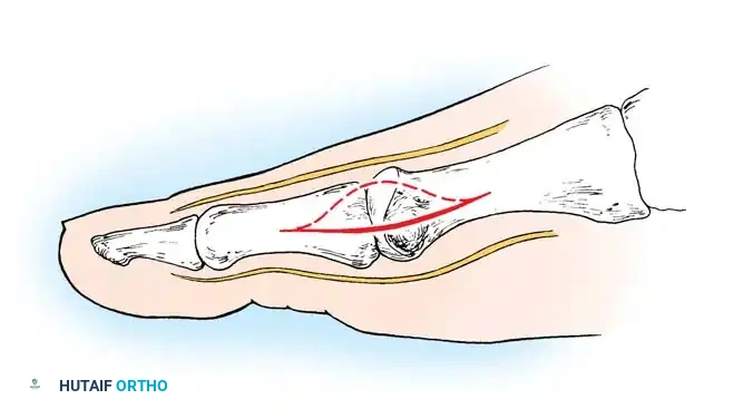 Fig. 78-13 Modifi ed McBride procedure: fi rst incision. Dotted line denotes dorsally curved incision; solid line indicates preferred incision (internervous plane).
