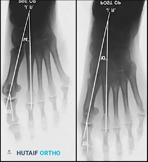Fig. 78-12 Hallux valgus treated by modifi ed McBride procedure. A, Preoperative deformity in 30-year-old patient. B, Correction obtained at surgery. C, Preoperative and postoperative radiographs (note fi bular sesamoid was not removed). More deformity can be corrected by fi bular sesamoidectomy, but overcorrection (hallux varus) is risk. If fi bular sesamoid is excised, medial capsule should be closed while holding hallux in 5 to 10 degrees valgus and kept in that position until capsular healing.