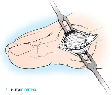Fig. 78-14 Modifi ed McBride procedure. Longitudinal capsular incision is 3 to 4 mm plantar to skin incision.