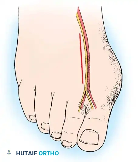 Disorders of the Hallux Surgical Diagram